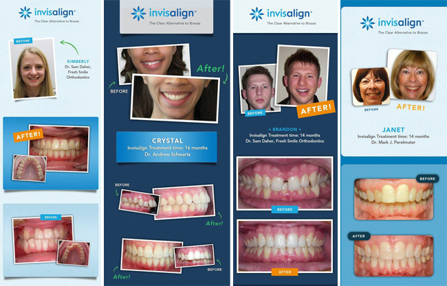 Invisalign vs Braces - Before and After Photos #InvisalignTalk