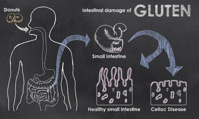 Before he had it, we had no idea what celiac disease was. See how it is different than gluten intolerance or allergy, what Celiac disease symptoms include, and why it we had to switch to only gluten free recipes.