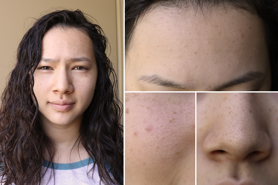 Custom teenage acne treatment w/ Curology - initial skin condition