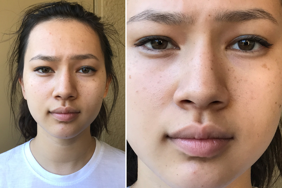 Custom teenage acne treatment w/ Curology - week 1, eye liner and mascara but no other makeup
