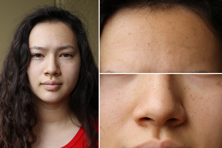 Custom teenage acne treatment w/ Curology - week 6